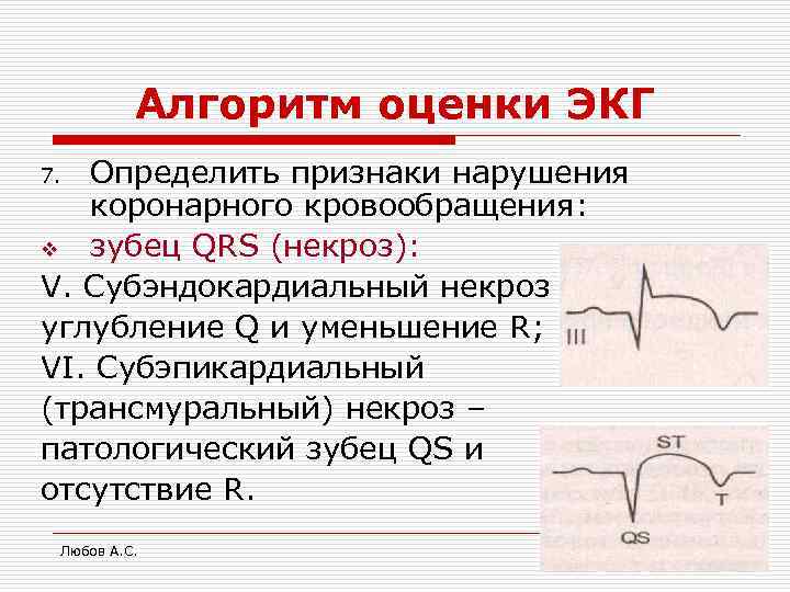 Алгоритм оценки ЭКГ Определить признаки нарушения коронарного кровообращения: v зубец QRS (некроз): V. Субэндокардиальный