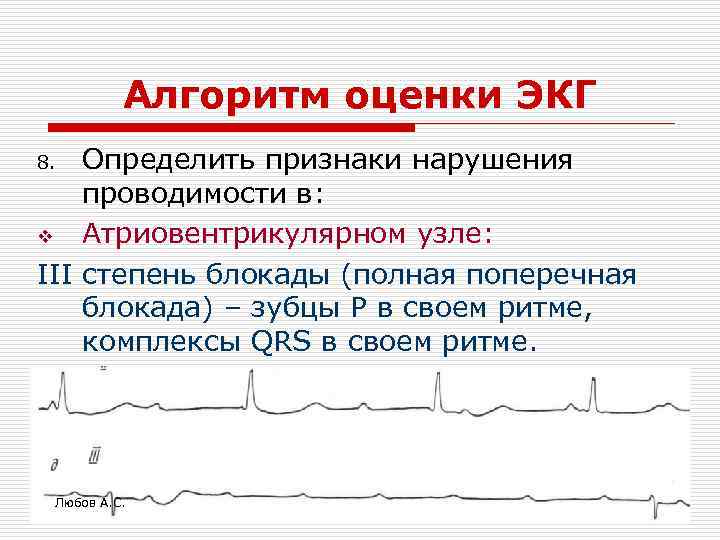 Алгоритм оценки ЭКГ Определить признаки нарушения проводимости в: v Атриовентрикулярном узле: III степень блокады