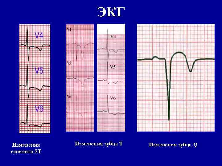 Изменения t. Неспецифические изменения зубца т на ЭКГ. Изменение сегмента St и зубца t на ЭКГ что это такое. Неспецифические изменения сегмента St. Сегмент St на ЭКГ отражает процесс.