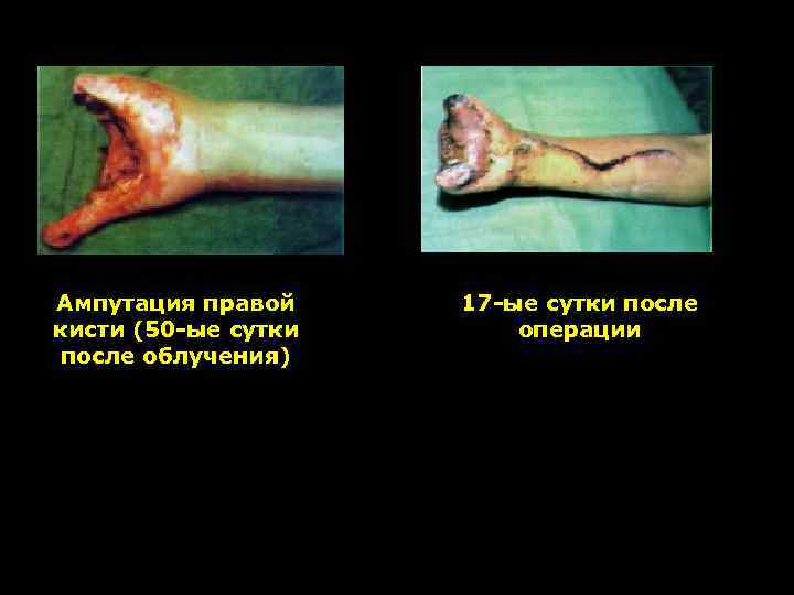 Ампутация правой кисти (50 -ые сутки после облучения) 17 -ые сутки после операции 