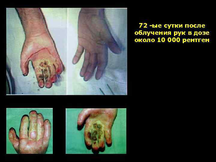 72 -ые сутки после облучения рук в дозе около 10 000 рентген 