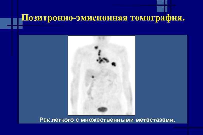 Позитронно-эмисионная томография. Рак легкого с множественными метастазами. 