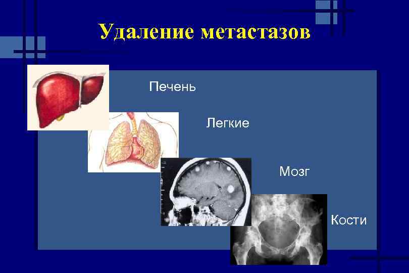 Удаление метастазов Печень Легкие Мозг Кости 