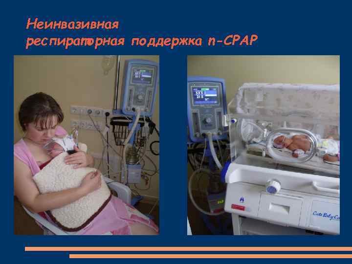 Неинвазивная респираторная поддержка n-СРАР 