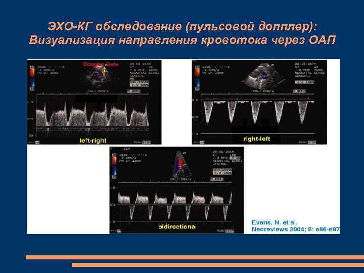 ЭХО-КГ обследование (пульсовой допплер): Визуализация направления кровотока через ОАП 