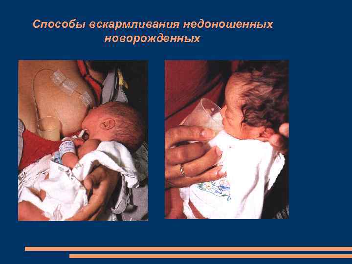 Способы вскармливания недоношенных новорожденных 