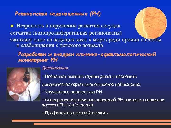 Ретинопатия недоношенных (РН) Незрелость и нарушение развития сосудов сетчатки (вазопролиферативная ретинопатия) занимает одно из