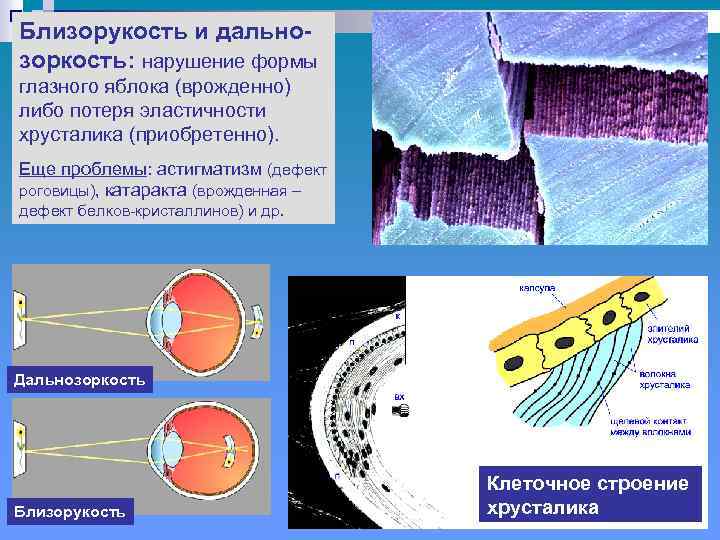Близорукость и дальнозоркость: нарушение формы глазного яблока (врожденно) либо потеря эластичности хрусталика (приобретенно). Еще