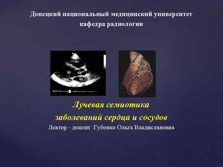 Донецкий национальный медицинский университет кафедра радиологии Лучевая семиотика заболеваний сердца и сосудов Лектор -