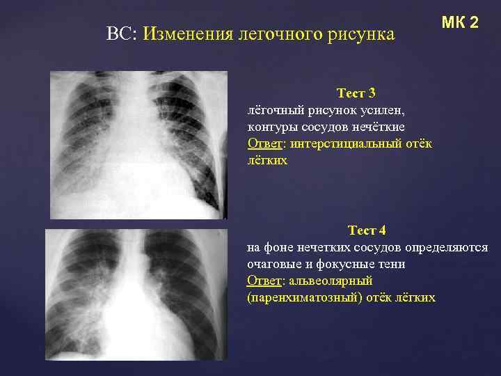 Компоненты легочного рисунка. Изменение легочного рисунка. Легочный рисунок усилен. Изменение легочного рисунка на рентгенограмме.