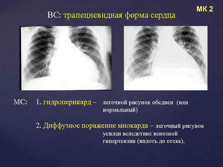 Усилен сосудистый компонент легочного рисунка