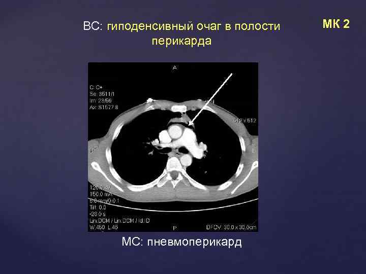 ВС: гиподенсивный очаг в полости перикарда МС: пневмоперикард МК 2 