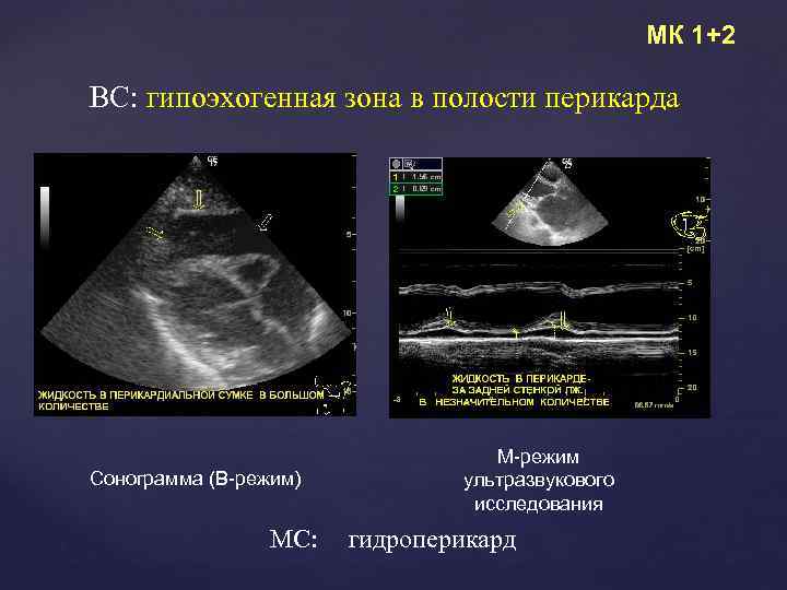 МК 1+2 ВС: гипоэхогенная зона в полости перикарда Сонограмма (В-режим) МС: М-режим ультразвукового исследования