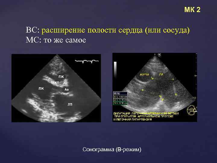 МК 2 ВС: расширение полости сердца (или сосуда) МС: то же самое Сонограмма (В-режим)