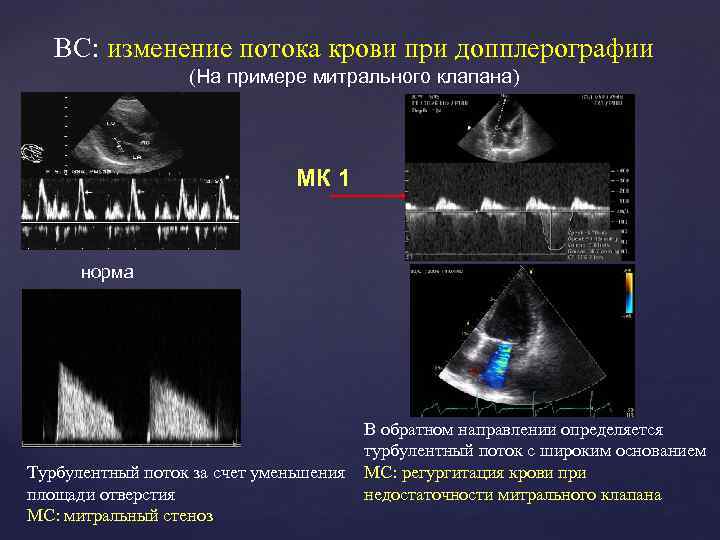 ВС: изменение потока крови при допплерографии (На примере митрального клапана) МК 1 норма Турбулентный