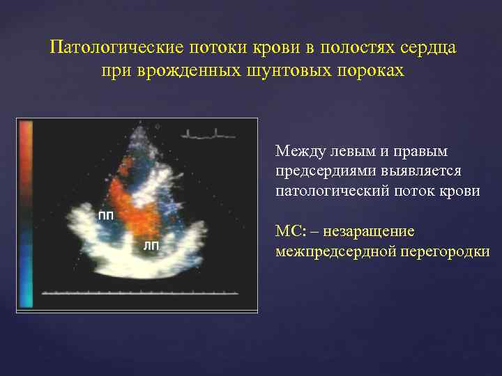 Патологические потоки крови в полостях сердца при врожденных шунтовых пороках Между левым и правым