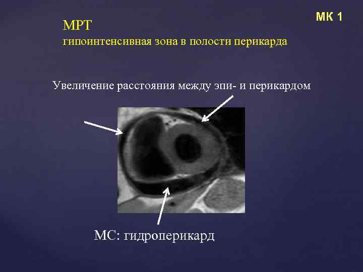 МК 1 МРТ гипоинтенсивная зона в полости перикарда Увеличение расстояния между эпи- и перикардом