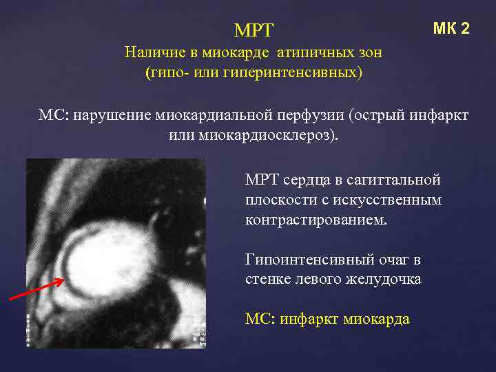 МРТ МК 2 Наличие в миокарде атипичных зон (гипо- или гиперинтенсивных) МС: нарушение миокардиальной