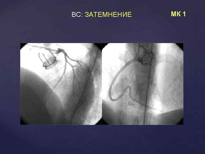 ВС: ЗАТЕМНЕНИЕ МК 1 