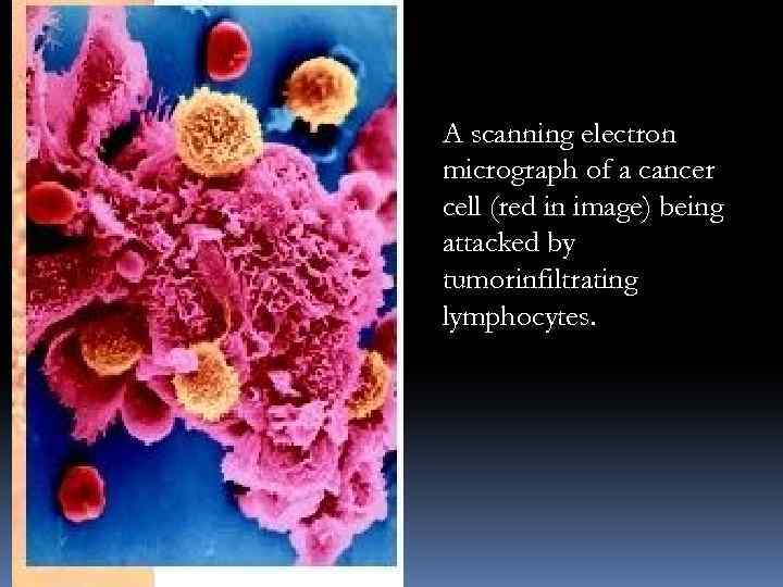 A scanning electron micrograph of a cancer cell (red in image) being attacked by