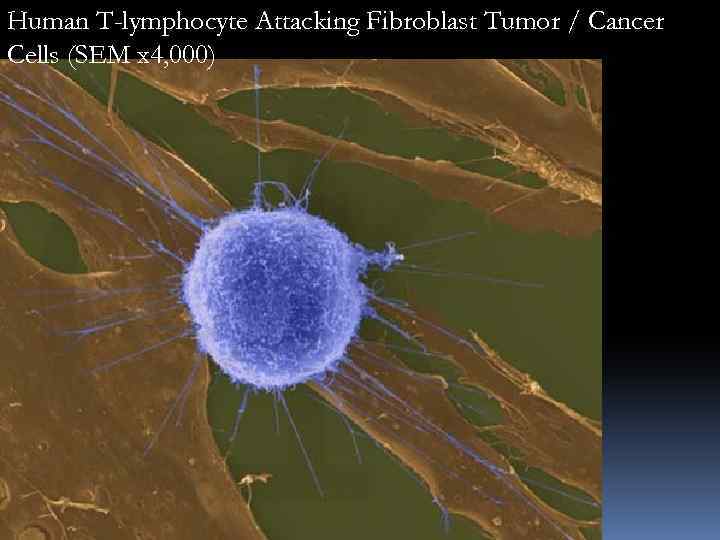 Human T-lymphocyte Attacking Fibroblast Tumor / Cancer Cells (SEM x 4, 000) 
