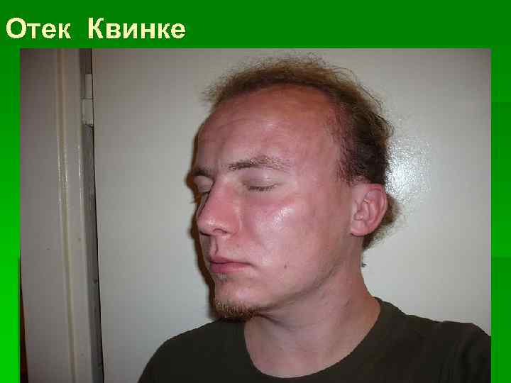 Отек Квинке 