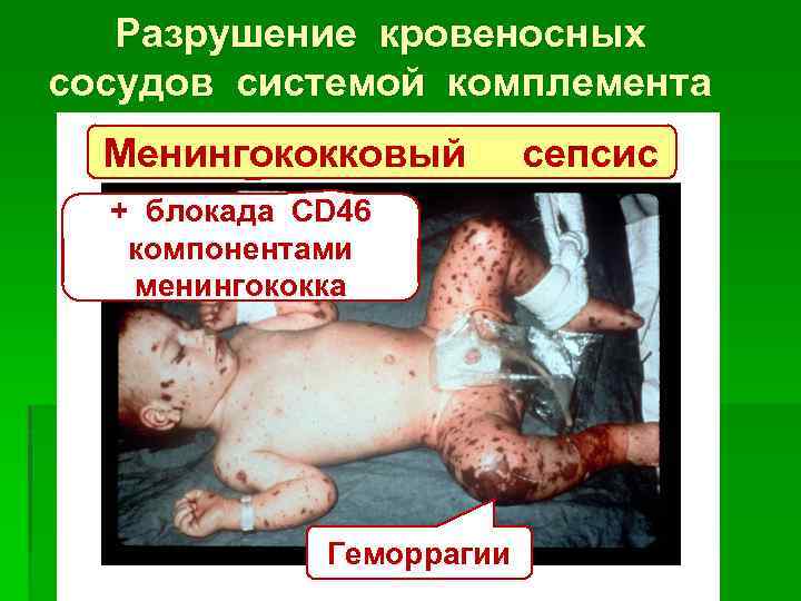 Разрушение кровеносных сосудов системой комплемента Менингококковый + блокада CD 46 компонентами менингококка Геморрагии сепсис