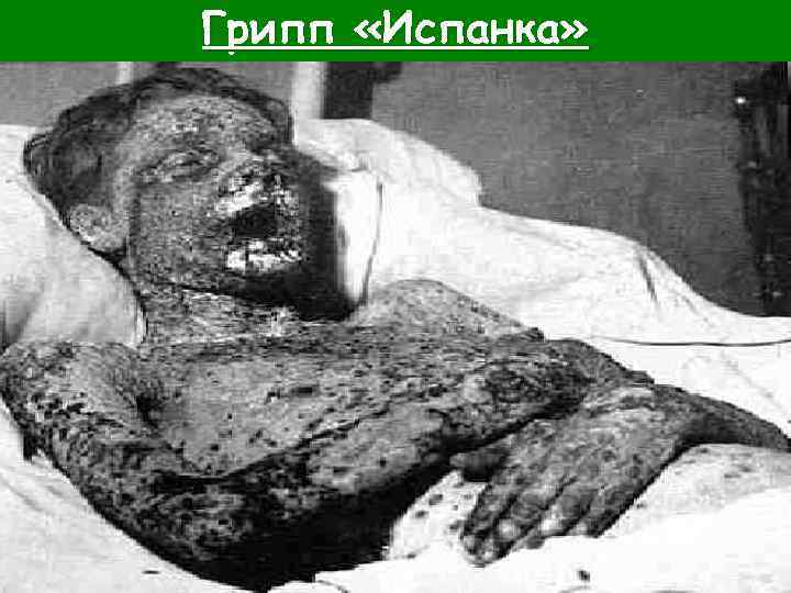 Грипп «Испанка» 
