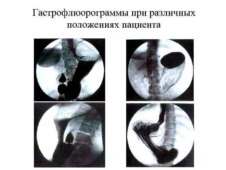 Гастрофлюорограммы при различных положениях пациента 