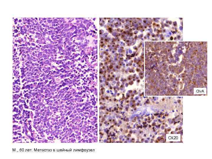 Chr. A СК 20 М. , 60 лет. Метастаз в шейный лимфоузел 