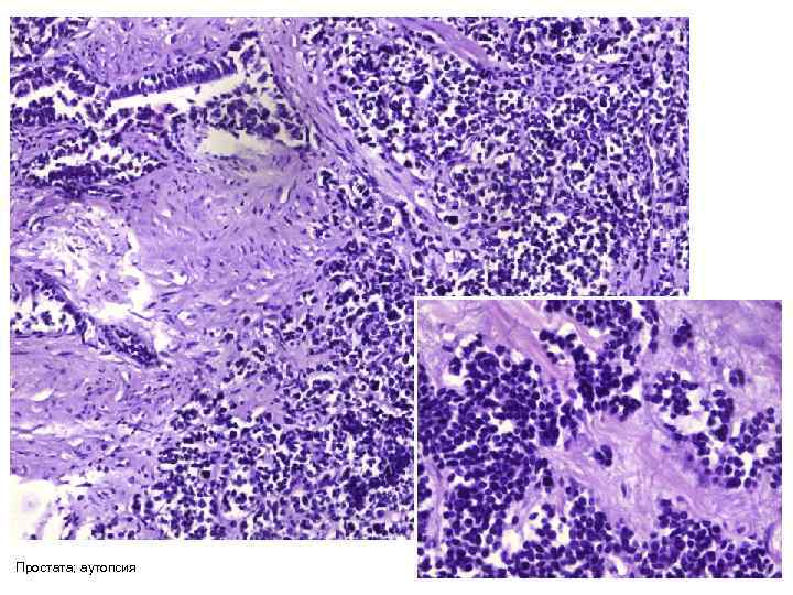 Простата; аутопсия 