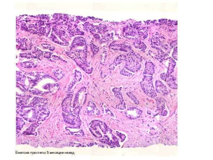 Биопсия простаты 5 месяцев назад 