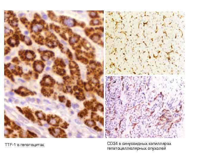 TTF-1 в гепатоцитах CD 34 в синусоидных капиллярах гепатоцеллюлярных опухолей 