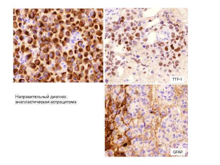 TTF-1 Направительный диагноз: анапластическая астроцитома GFАР 
