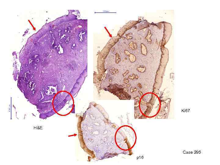 Ki 67 H&E Case 295 p 16 