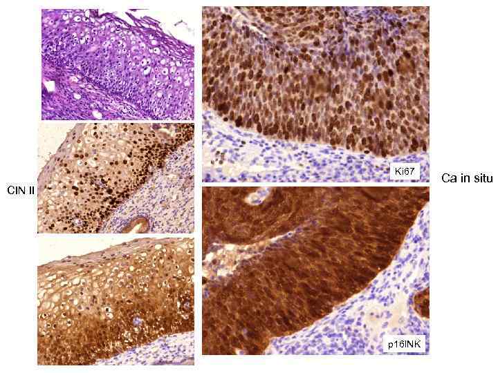 Ki 67 CIN II p 16 INK Ca in situ 