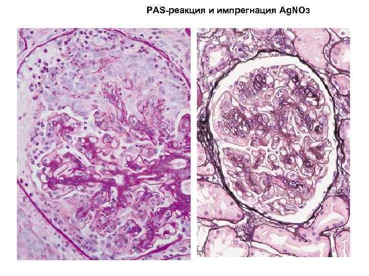 PAS-реакция и импрегнация Ag. NOз 