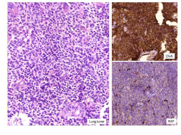 Chr. A Lung tumor Ki 67 
