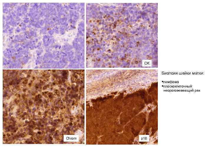 CK Биопсия шейки матки: §лимфома §плоскоклеточный неороговевающий рак Chrom p 16 