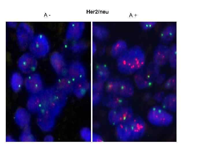 А- Her 2/neu А+ 