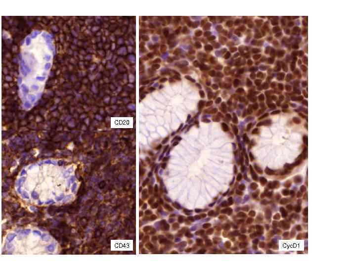 CD 20 CD 43 Cyc. D 1 