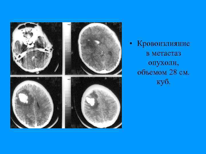  • Кровоизлияние в метастаз опухоли, объемом 28 см. куб. 