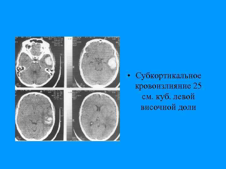  • Субкортикальное кровоизлияние 25 см. куб. левой височной доли 