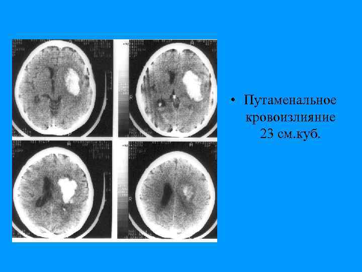  • Путаменальное кровоизлияние 23 см. куб. 