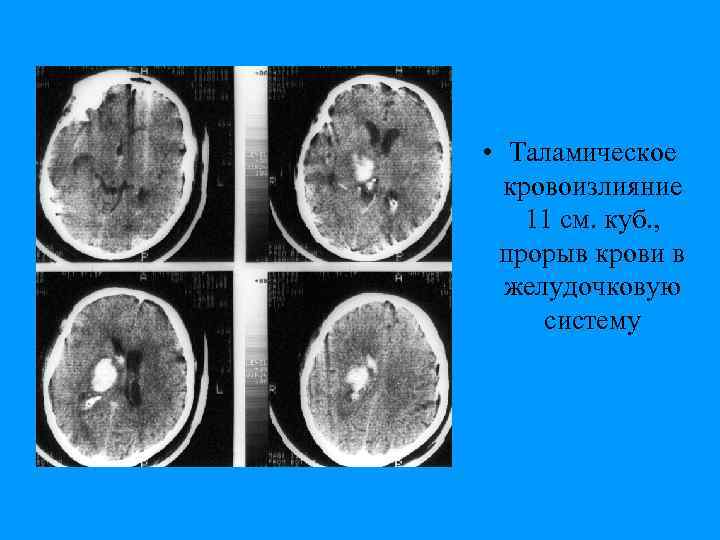  • Таламическое кровоизлияние 11 см. куб. , прорыв крови в желудочковую систему 