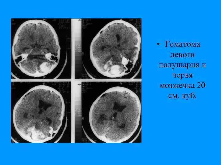  • Гематома левого полушария и червя мозжечка 20 см. куб. 