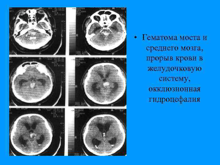  • Гематома моста и среднего мозга, прорыв крови в желудочковую систему, окклюзионная гидроцефалия