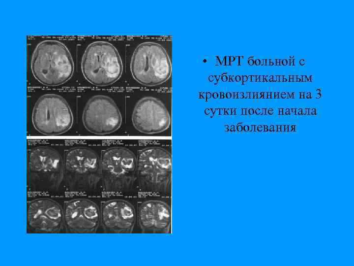  • МРТ больной с субкортикальным кровоизлиянием на 3 сутки после начала заболевания 