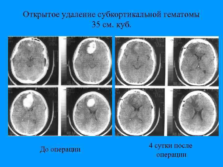 Открытое удаление субкортикальной гематомы 35 см. куб. До операции 4 сутки после операции 
