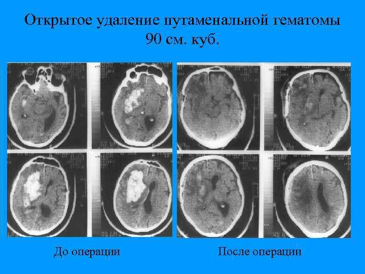 Открытое удаление путаменальной гематомы 90 см. куб. До операции После операции 